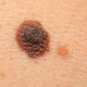 Posnetek, ki s časovnim zamikom prikazuje, kako se znamenje spremeni v melanom