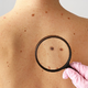 Ob dnevu boja proti kožnemu melanomu poudarek na preventivi in zgodnjem odkrivanju